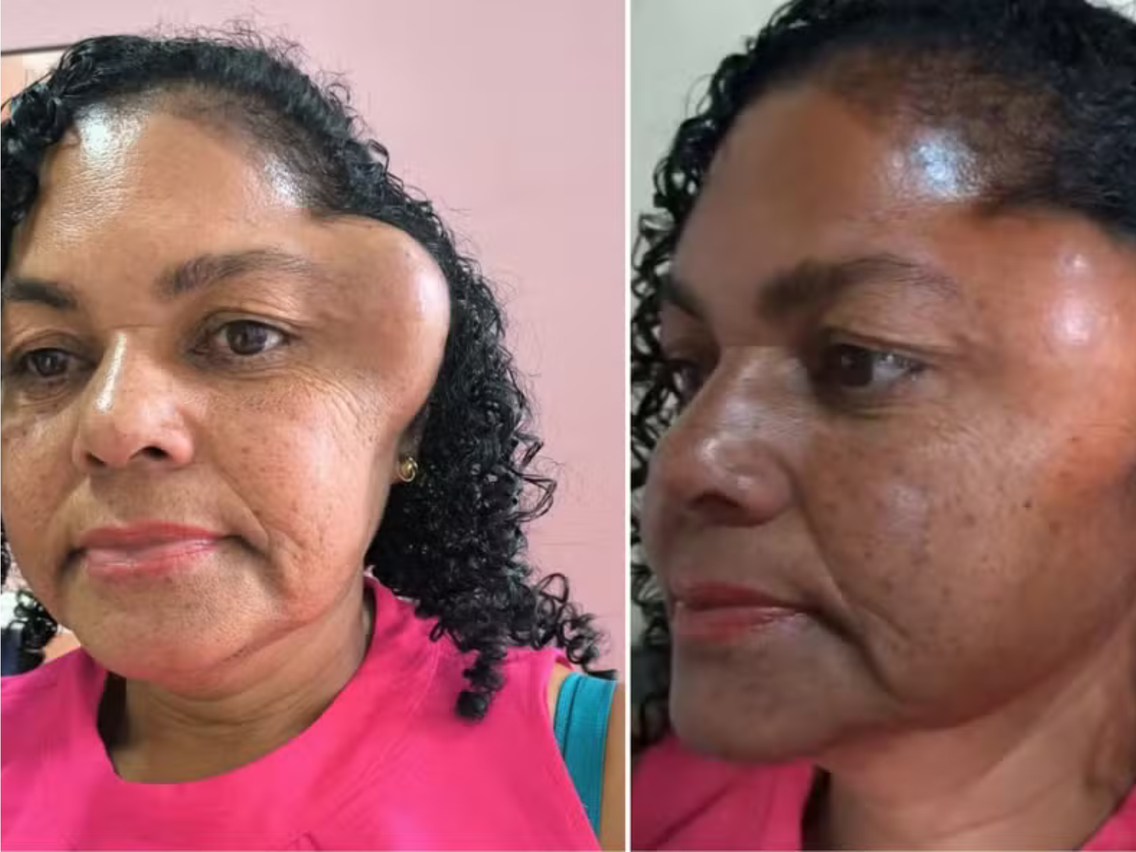 Paciente com tumor no rosto espera cirurgia há mais de um ano no RN